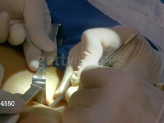 Aj sotavento desde wwe consigue su third pecho implant: gratis x calificación presilla 8e